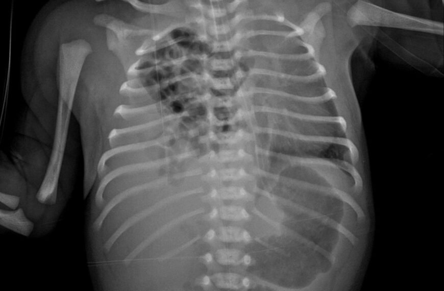 جراحة نادرة تنقذ حياة طفل من فتق حجابي أيمن من نوع بوكدالك بمستشفى زاوية الناعورة المركزي