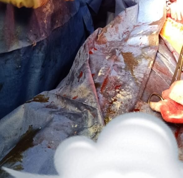 ولادتان قيصريتان ناجحتان في ظروف دقيقة بمستشفى أشمون العام