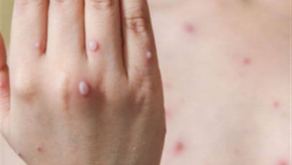 إصابة 12 تلميذًا بالجديري في مدرسة بالباجور