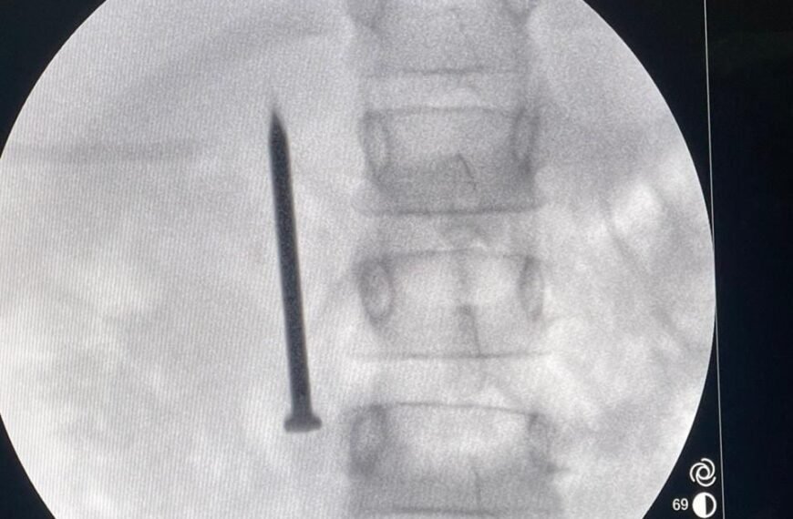 نجاح فريق طبي بمعهد الكبد القومي بجامعة المنوفية في استخراج مسمار حاد من أمعاء طفلة ٧ سنوات