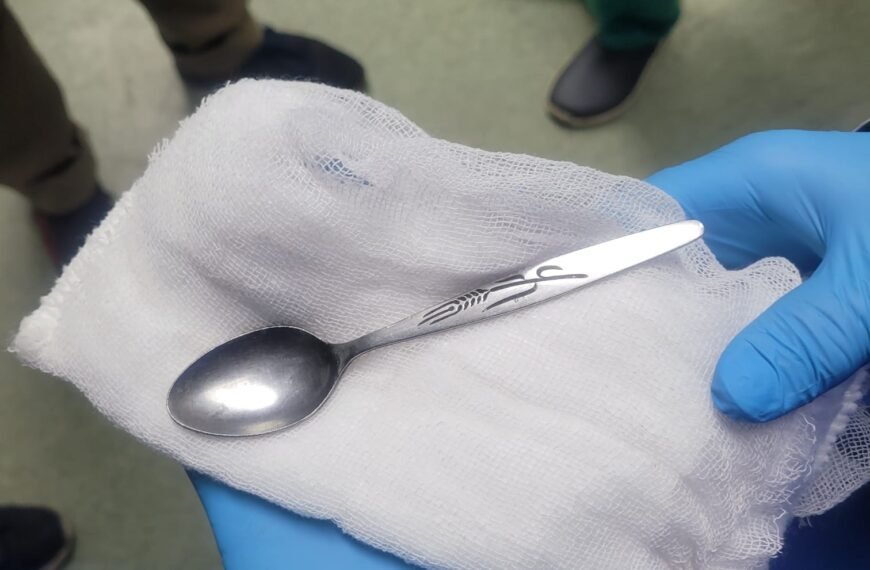 إنقاذ مريضة ابتلعت “ملعقة” بمستشفى معهد الكبد القومي باستخدام المنظار…